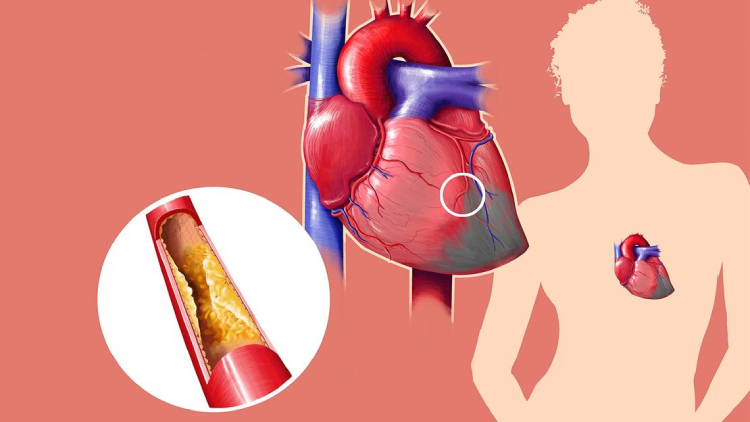 What Are the Symptoms of Cholesterol Problems?
