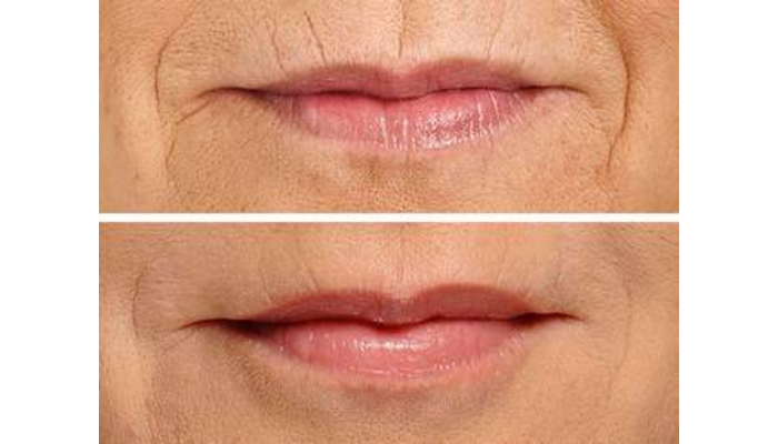 What Happens If You Stop Getting Juvederm? Understanding The Long-Term Effects