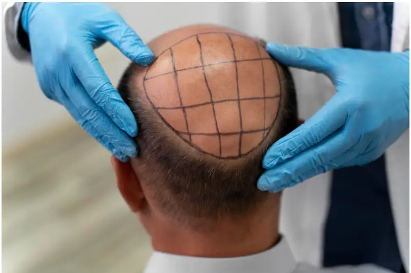 Why Is Turkey So Affordable For Hair Transplants Now?